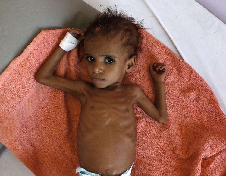 Lille underernæret dreng i Yemen