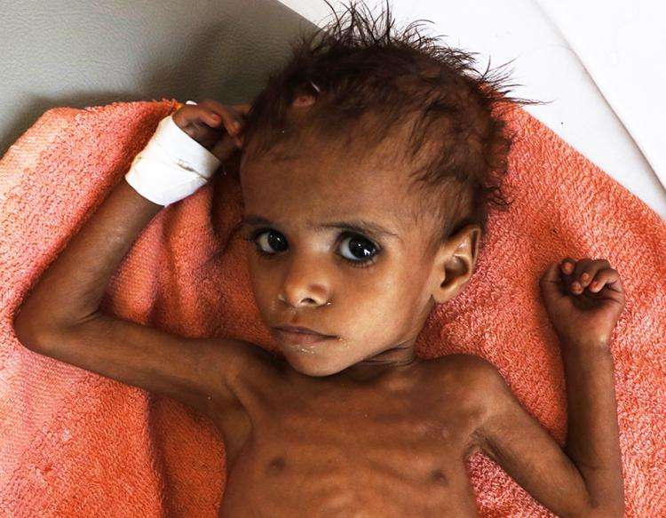 Yemens børn sulter