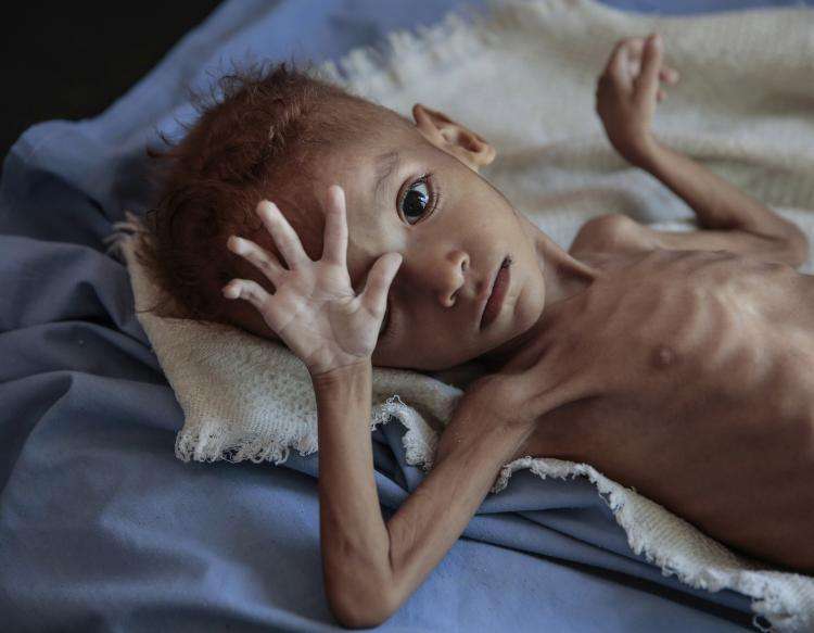 Underernæret dreng fra Yemen