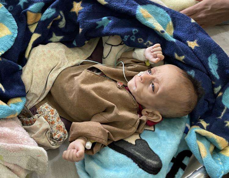 Dreng i Afghanistan er akut underernæret