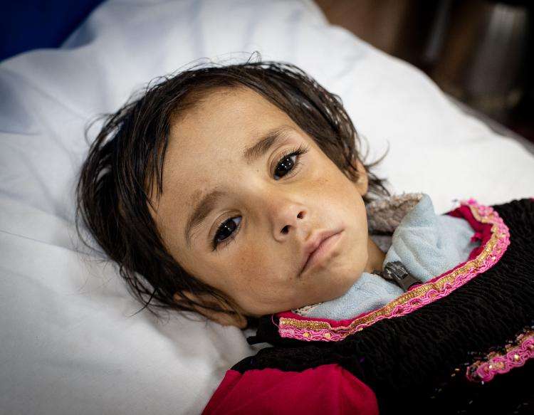 Et alvorligt underernæret barn i  Afghanistan